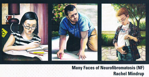 RACHEL MINDRUP Many Faces of Neurofibromatosis (NF) 